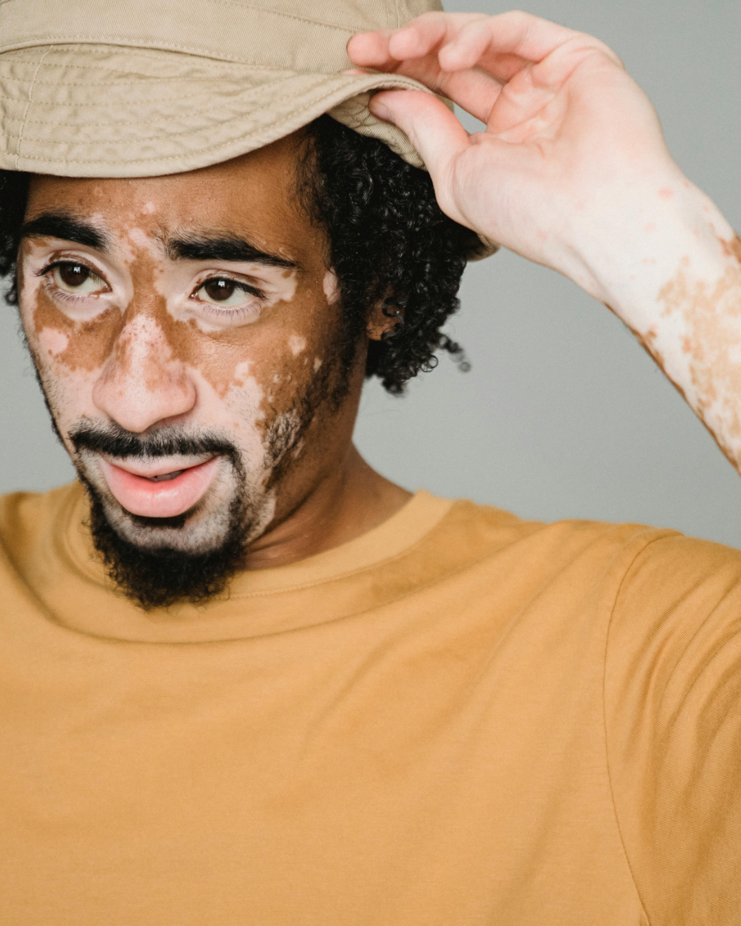 March is National Autoimmune Disease Awareness Month: How Dermatologists Help Manage Autoimmune Skin Conditions